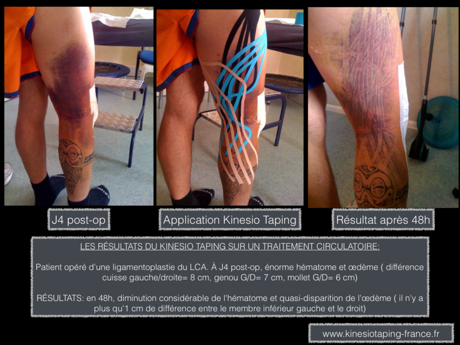 Osteopathie et Kinesio Taping, strapping